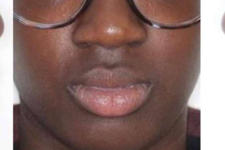 Clínica Zahara explica qué es el mentón Fuyant y cómo tratarlo
