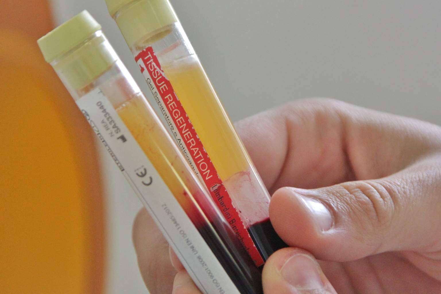 Tratar una enfermedad o lesión usando las células, tejidos u órganos del paciente, gracias a la medicina regenerativa