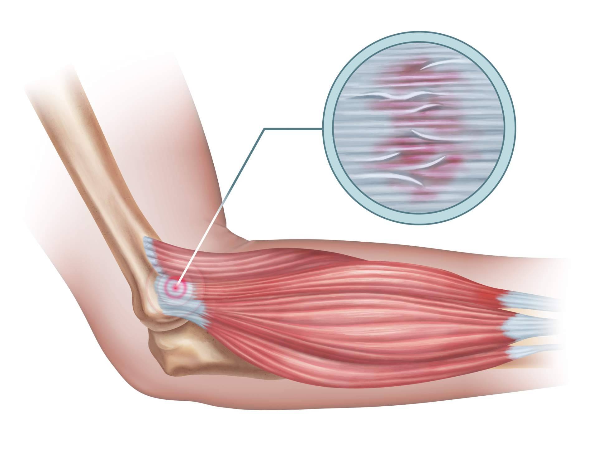 ¿Qué es y cómo mejorar la tendinitis con entrenamiento de fuerza?