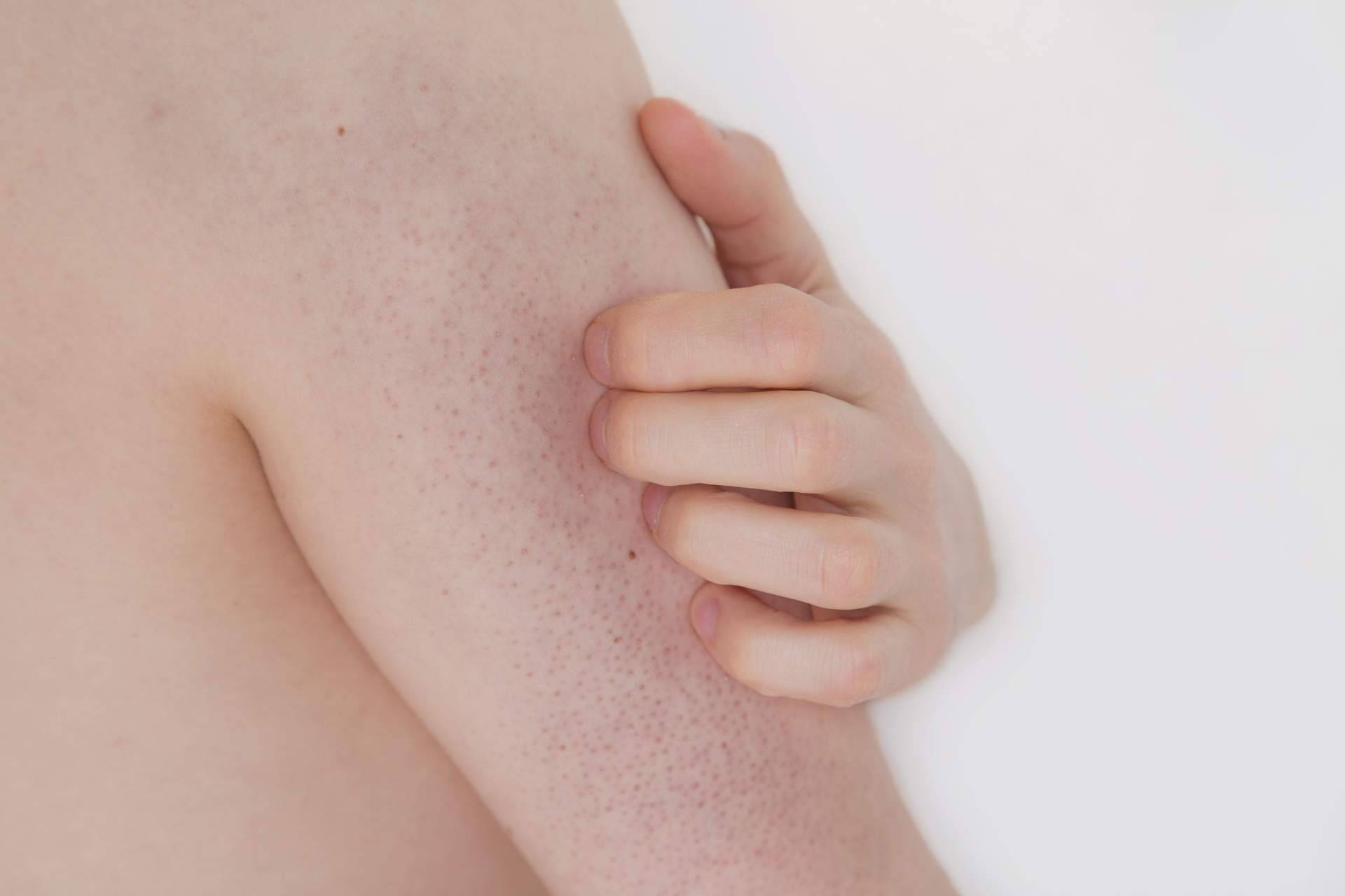 Cómo mitigar los síntomas de la queratosis pilaris, por la Dra. Janeth Arévalo