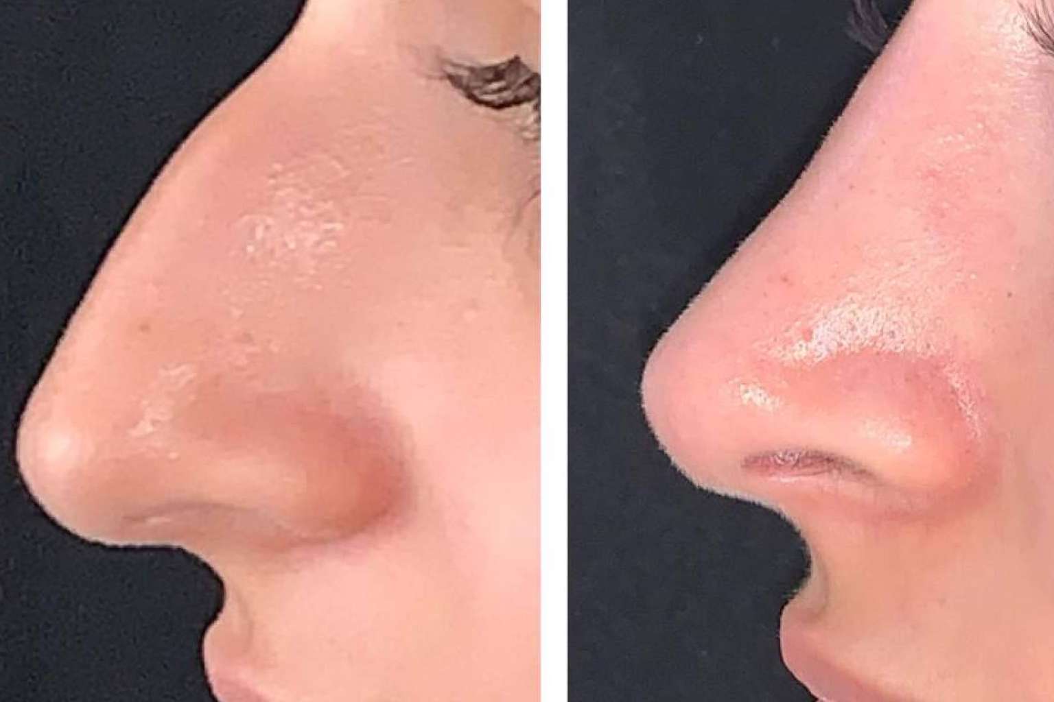 Rinoplastia ultrasónica; La Revolución en Cirugía Nasal
