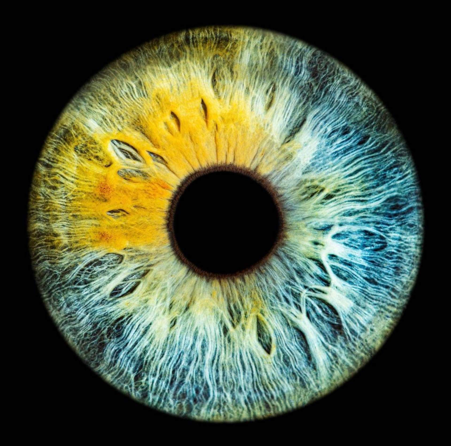 Nevus oculares, las pecas que pueden aparecer en los ojos