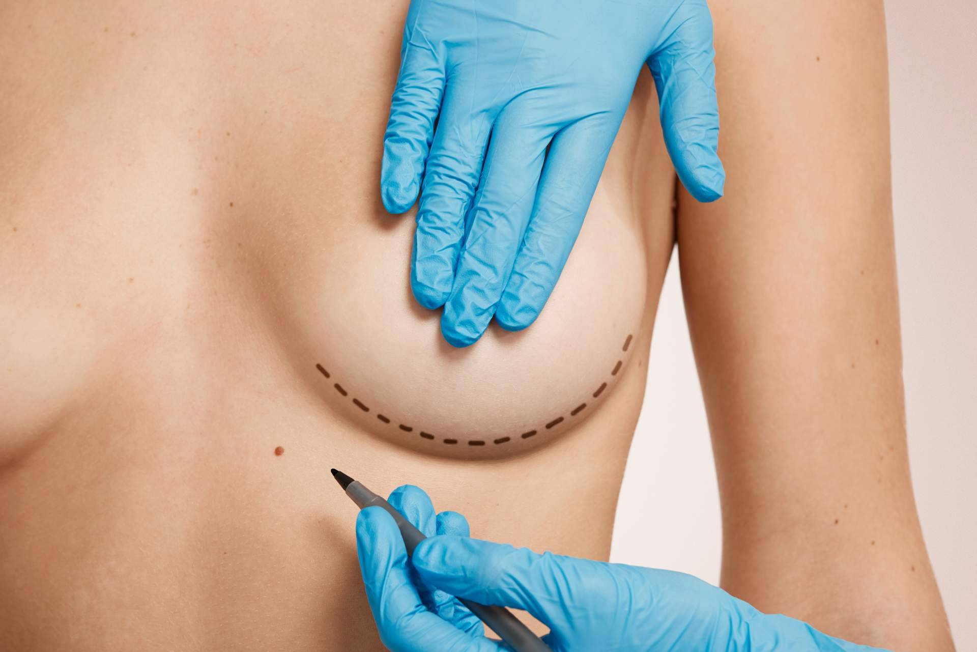 Corrección de la malformación de las glándulas mamarias en Beauty & Beauty