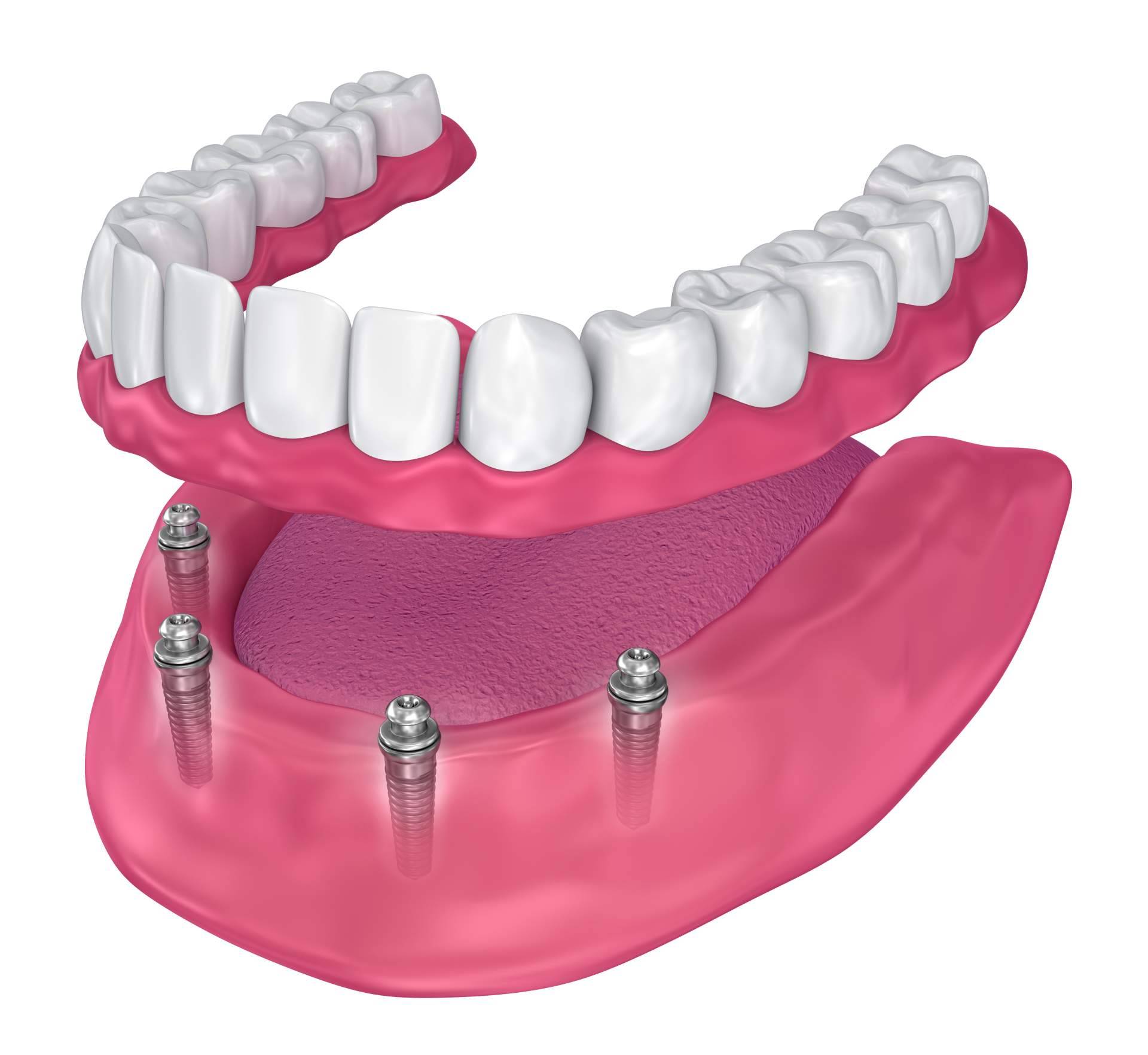 Madrid confía en Clínica Jorge del Corral para implantes dentales de excelencia