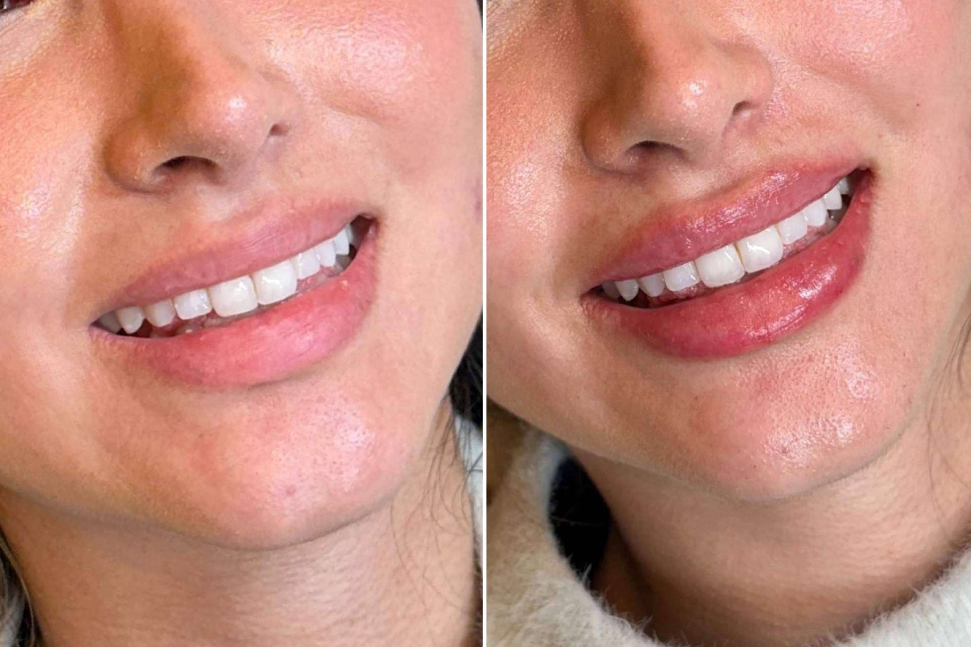 Holaglow revoluciona la armonización labial con Glow Lips, un tratamiento de precisión y naturalidad