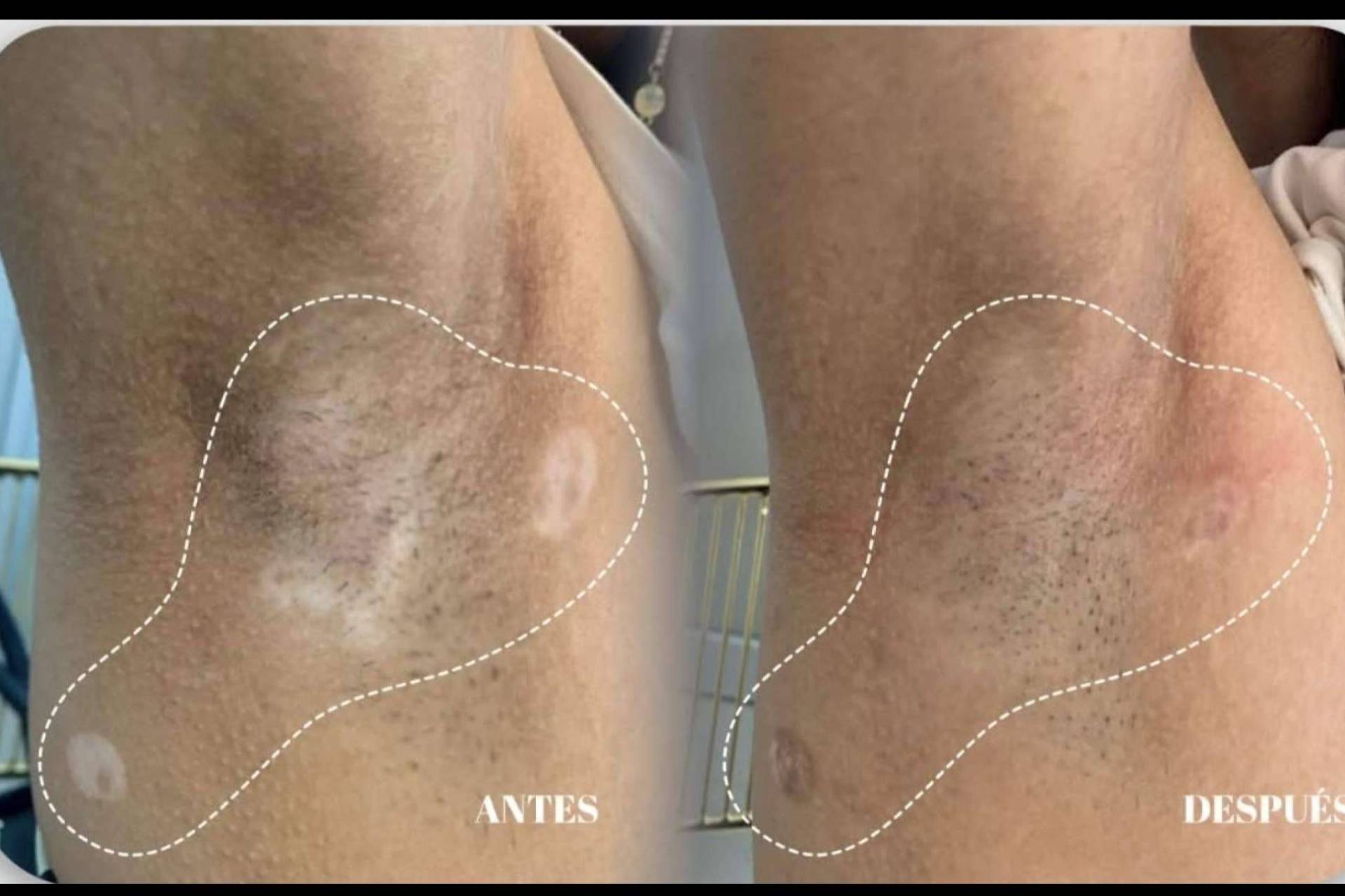 Terapia combinada para el vitiligo; el enfoque dermatológico de la Dra. Janeth Arévalo en Loja