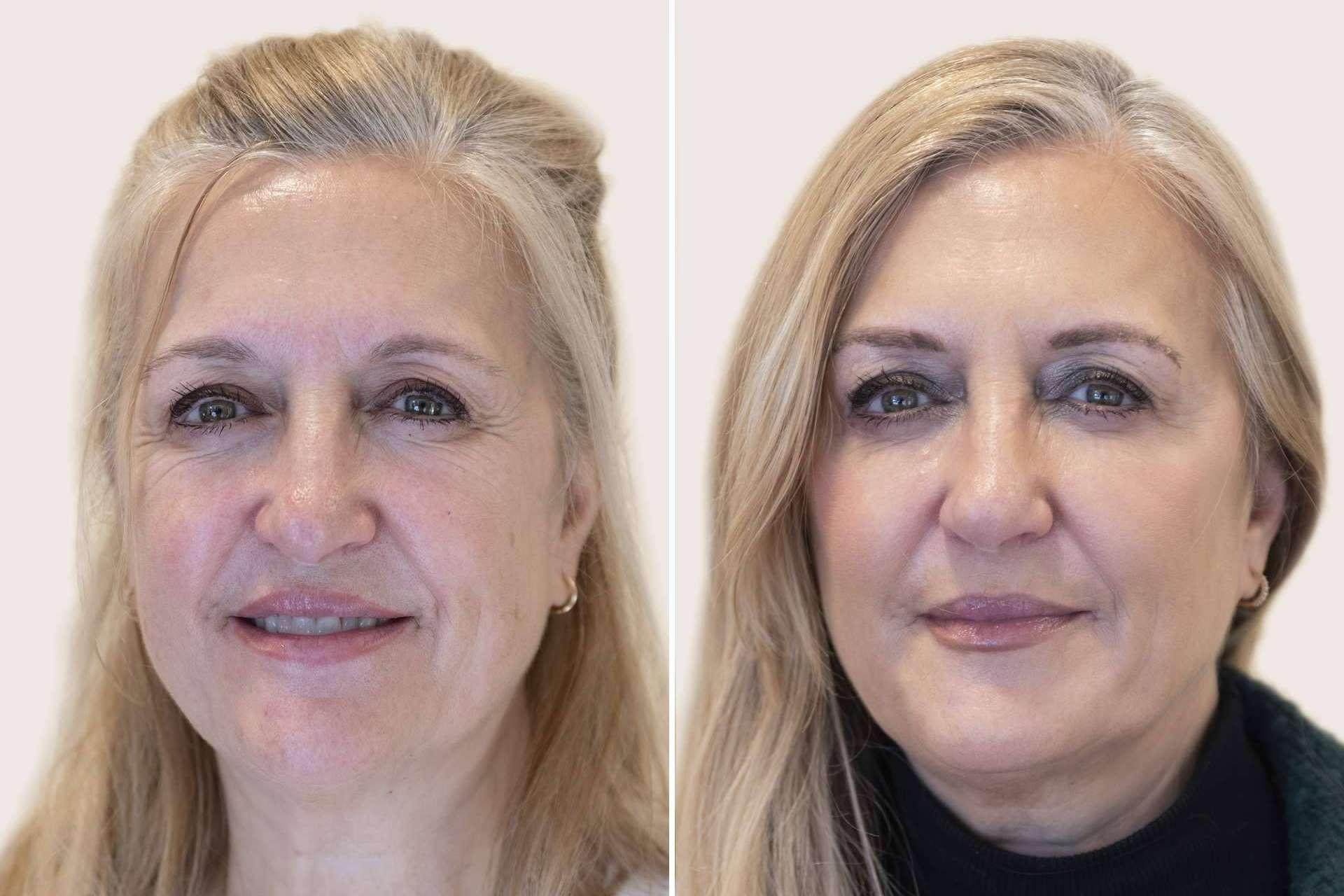 Armonización facial, el secreto 'celeb' para estar más guap@ a los 50 que a los 20
