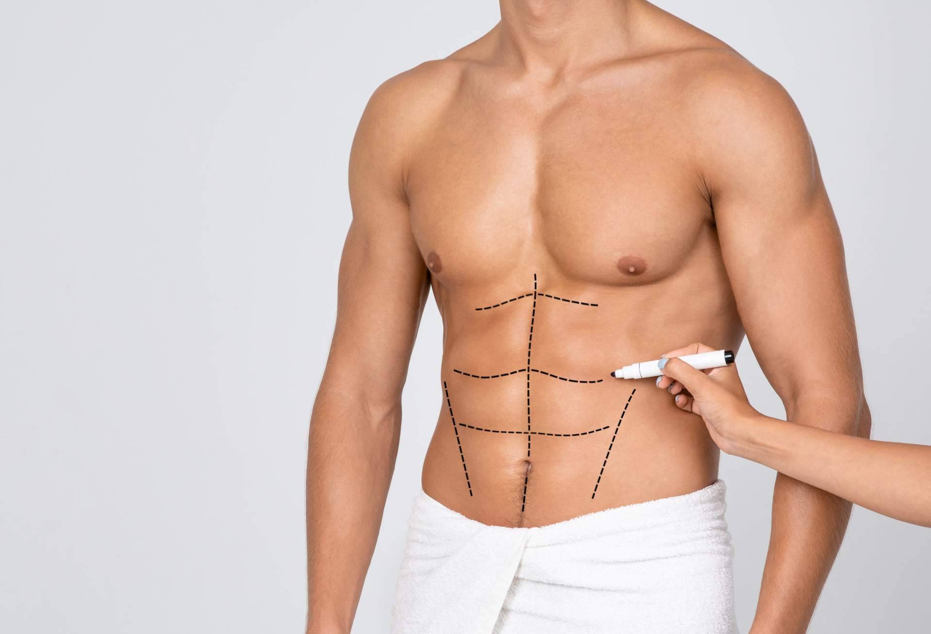 Lipo Váser, abdominoplastia y blefaroplastia; las cirugías más demandadas por los hombres