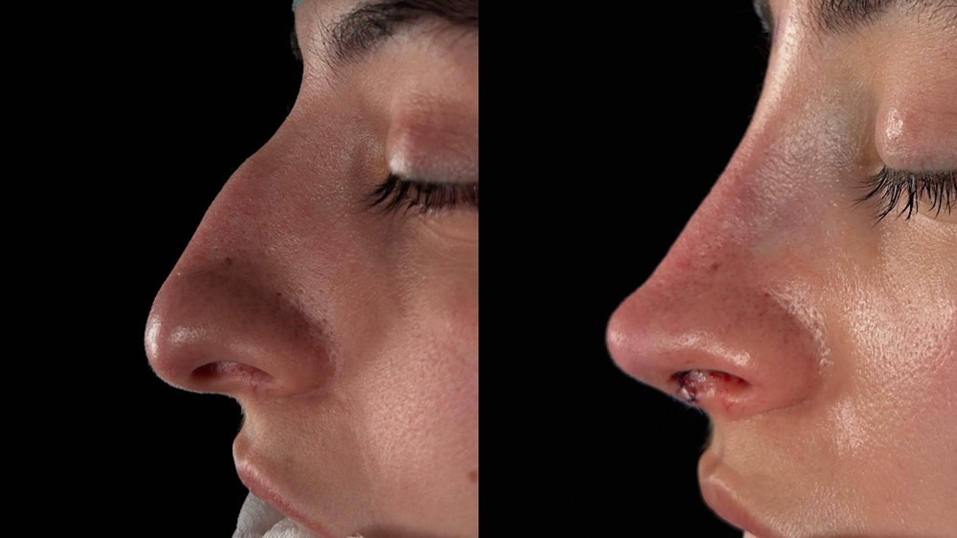 Miedo a la rinoplastia; la barrera emocional de no reconocerse tras la cirugía